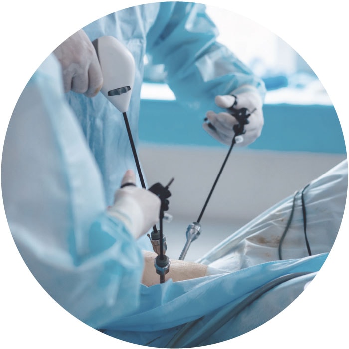 Laparoscopy